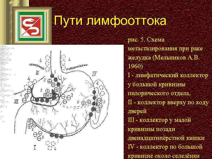 Пути лимфооттока рис. 5. Схема метастазирования при раке желудка (Мельников А. В. 1960) I