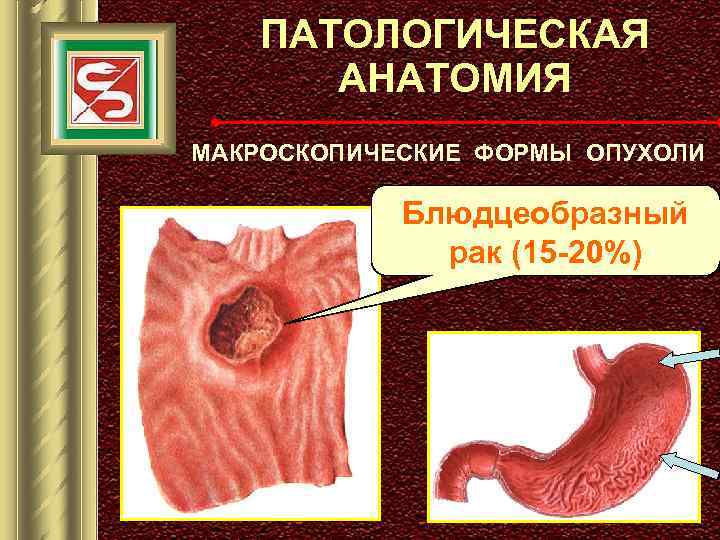 ПАТОЛОГИЧЕСКАЯ АНАТОМИЯ МАКРОСКОПИЧЕСКИЕ ФОРМЫ ОПУХОЛИ Блюдцеобразный рак (15 -20%) 