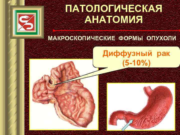 ПАТОЛОГИЧЕСКАЯ АНАТОМИЯ МАКРОСКОПИЧЕСКИЕ ФОРМЫ ОПУХОЛИ Диффузный рак (5 -10%) 