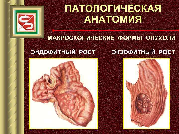 ПАТОЛОГИЧЕСКАЯ АНАТОМИЯ МАКРОСКОПИЧЕСКИЕ ФОРМЫ ОПУХОЛИ ЭНДОФИТНЫЙ РОСТ ЭКЗОФИТНЫЙ РОСТ 