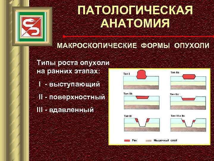 ПАТОЛОГИЧЕСКАЯ АНАТОМИЯ МАКРОСКОПИЧЕСКИЕ ФОРМЫ ОПУХОЛИ Типы роста опухоли на ранних этапах: I - выступающий