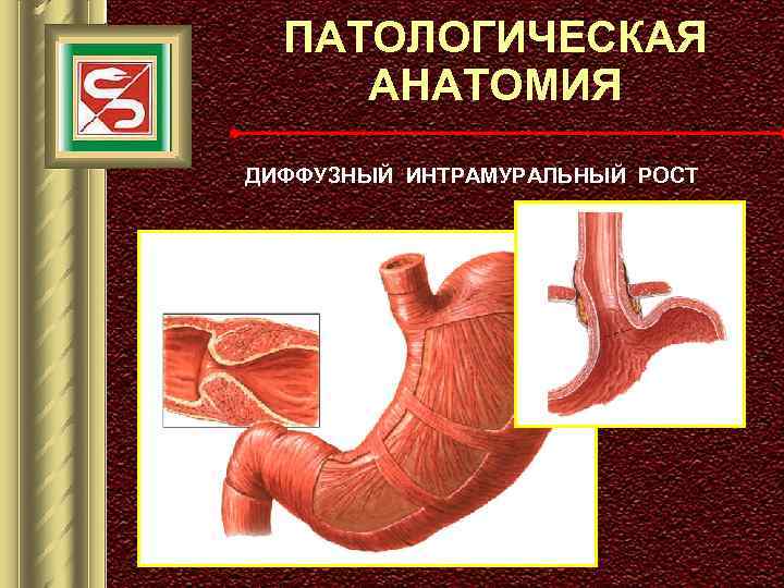 ПАТОЛОГИЧЕСКАЯ АНАТОМИЯ ДИФФУЗНЫЙ ИНТРАМУРАЛЬНЫЙ РОСТ 