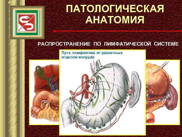 ПАТОЛОГИЧЕСКАЯ АНАТОМИЯ РАСПРОСТРАНЕНИЕ ПО ЛИМФАТИЧЕСКОЙ СИСТЕМЕ 