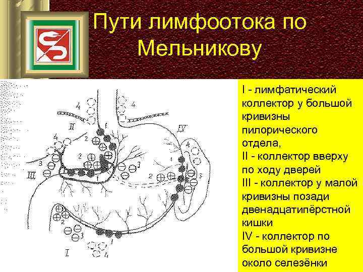 Пути лимфоотока по Мельникову I - лимфатический коллектор у большой кривизны пилорического отдела, II