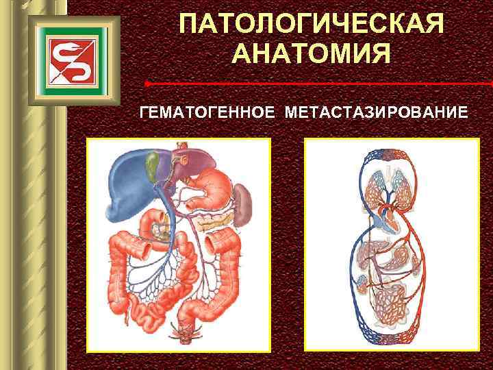 ПАТОЛОГИЧЕСКАЯ АНАТОМИЯ ГЕМАТОГЕННОЕ МЕТАСТАЗИРОВАНИЕ 