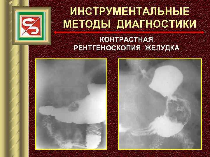 ИНСТРУМЕНТАЛЬНЫЕ МЕТОДЫ ДИАГНОСТИКИ КОНТРАСТНАЯ РЕНТГЕНОСКОПИЯ ЖЕЛУДКА 