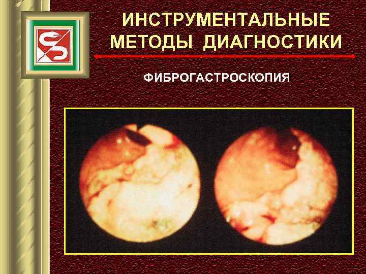 ИНСТРУМЕНТАЛЬНЫЕ МЕТОДЫ ДИАГНОСТИКИ ФИБРОГАСТРОСКОПИЯ 