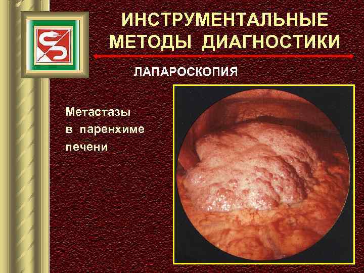 ИНСТРУМЕНТАЛЬНЫЕ МЕТОДЫ ДИАГНОСТИКИ ЛАПАРОСКОПИЯ Метастазы в паренхиме печени 