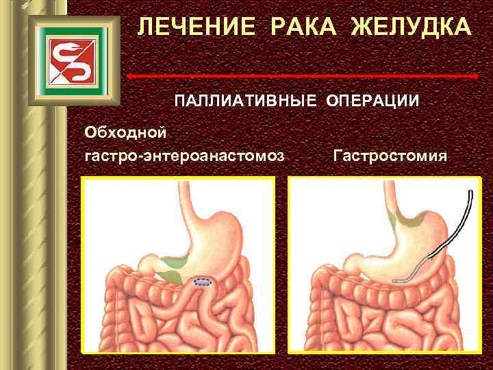 ЛЕЧЕНИЕ РАКА ЖЕЛУДКА ПАЛЛИАТИВНЫЕ ОПЕРАЦИИ Обходной гастро-энтероанастомоз Гастростомия 