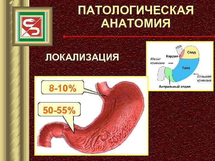 ПАТОЛОГИЧЕСКАЯ АНАТОМИЯ ЛОКАЛИЗАЦИЯ 8 -10% 50 -55% 