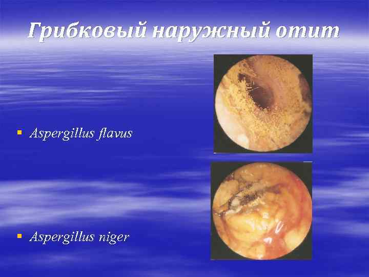 Грибковый наружный отит § Aspergillus flavus § Aspergillus niger 