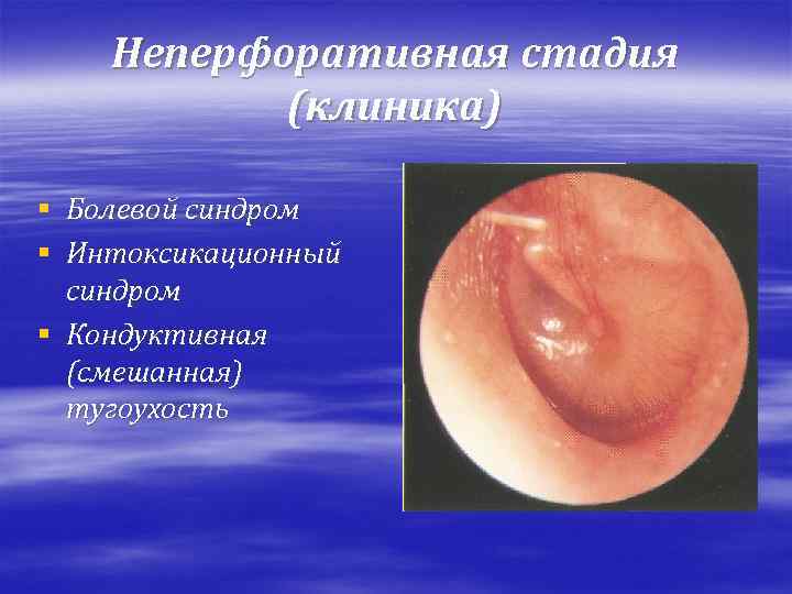 Неперфоративная стадия (клиника) § Болевой синдром § Интоксикационный синдром § Кондуктивная (смешанная) тугоухость 