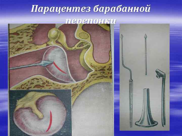 Парацентез барабанной перепонки 