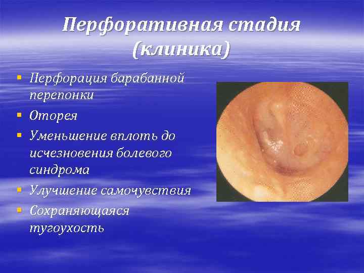 Перфоративная стадия (клиника) § Перфорация барабанной перепонки § Оторея § Уменьшение вплоть до исчезновения