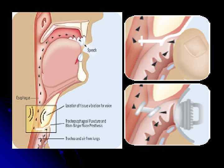 Голосовой протез. Протезирование гортани. Анатомия гортани эндоскопия. Устанавливающий аппарат гортани анатомия.