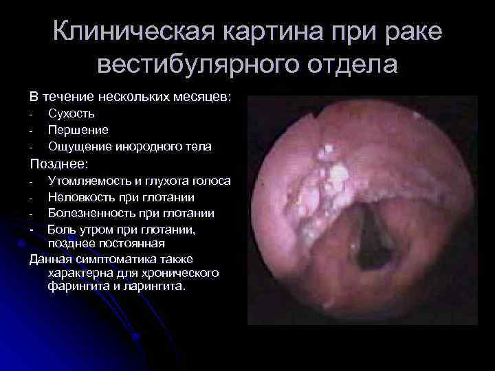 Клиническая картина при раке вестибулярного отдела В течение нескольких месяцев: - Сухость Першение Ощущение