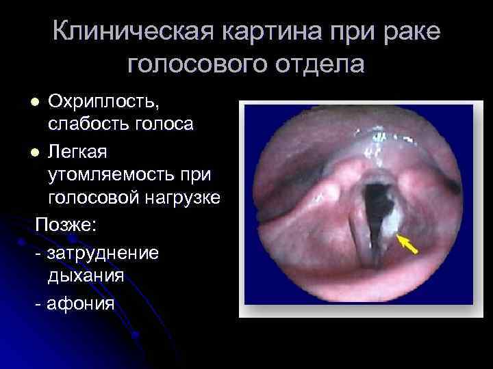 Клиническая картина при раке голосового отдела Охриплость, слабость голоса l Легкая утомляемость при голосовой