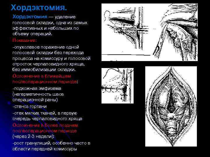 Хордэктомия — удаление голосовой складки, одна из самых эффективных и небольших по объему операций.
