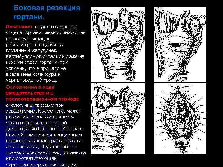 Боковая резекция гортани. Показания: опухоли среднего отдела гортани, иммобилизующие голосовую складку, распространяющиеся на гортанный