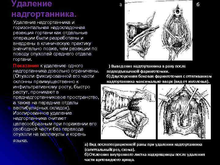 Отдельный операция. Удаление надгортанника. Операция на надгортаннике. Резекция надгортанника.