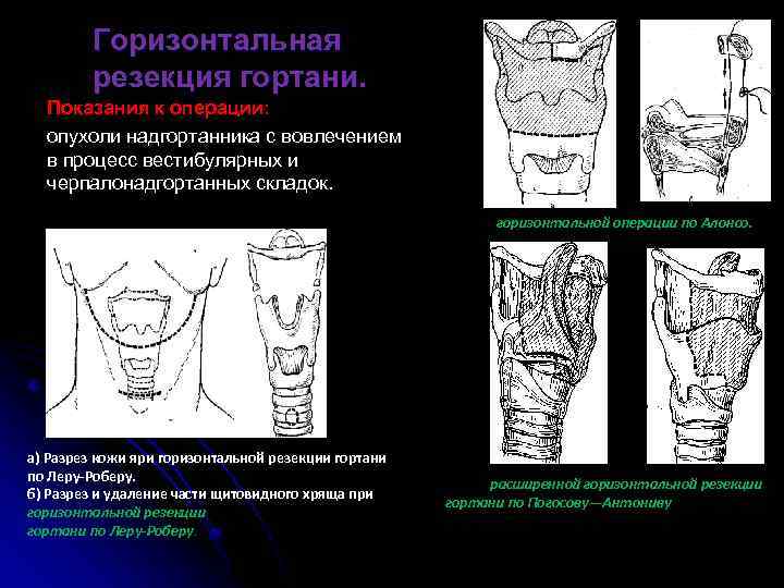 Горизонтальная резекция гортани. Показания к операции: опухоли надгортанника с вовлечением в процесс вестибулярных и