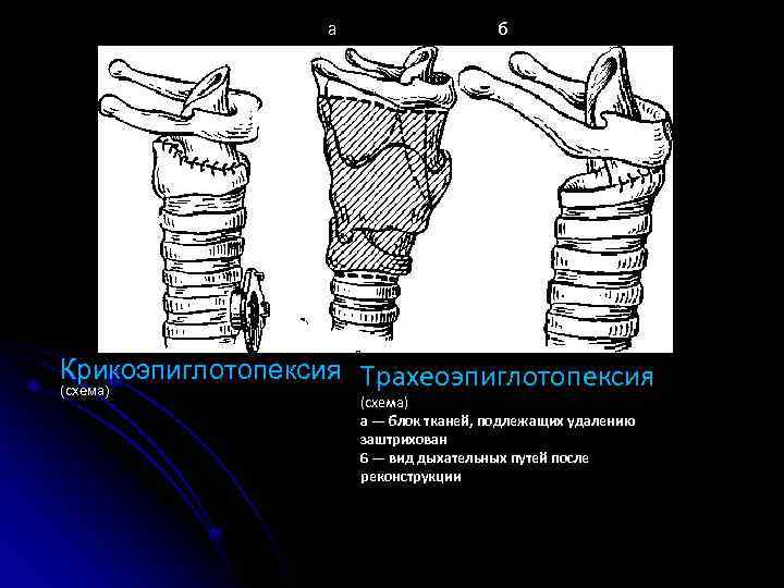 а б Крикоэпиглотопексия Трахеоэпиглотопексия (схема) а — блок тканей, подлежащих удалению заштрихован 6 —