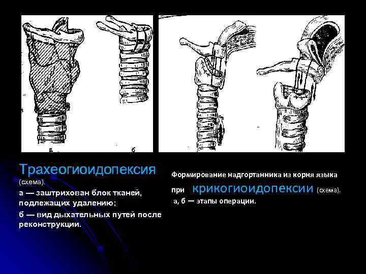 Трахеогиоидопексия (схема). а — заштрихован блок тканей, подлежащих удалению; б — вид дыхательных путей
