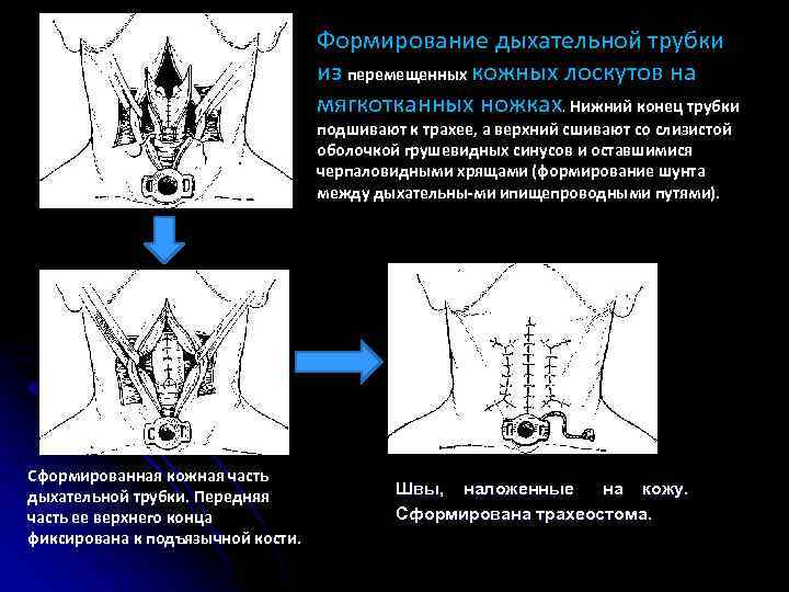 Формирование дыхательной трубки из перемещенных кожных лоскутов на мягкотканных ножках. Нижний конец трубки подшивают