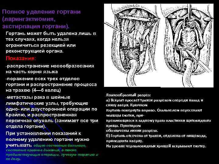 Полное удаление гортани (ларингэктиомия, экстирпация гортани). Гортань может быть удалена лишь в тех случаях,