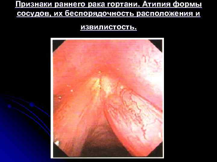 Признаки раннего рака гортани. Атипия формы сосудов, их беспорядочность расположения и извилистость. 