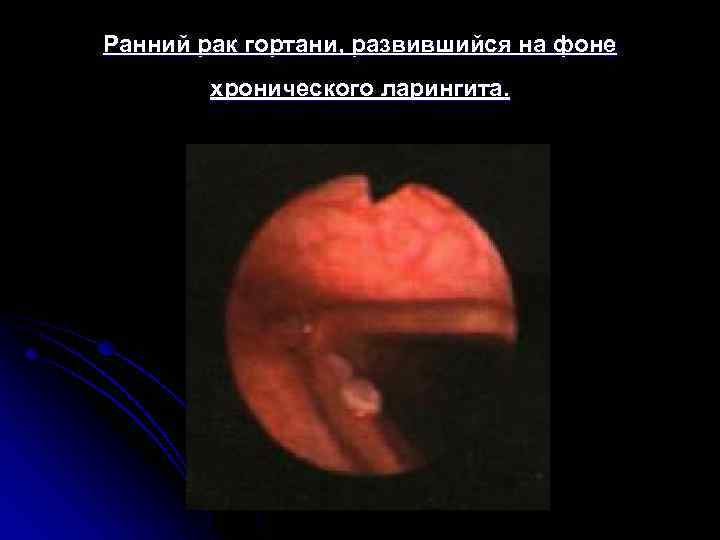 Ранний рак гортани, развившийся на фоне хронического ларингита. 