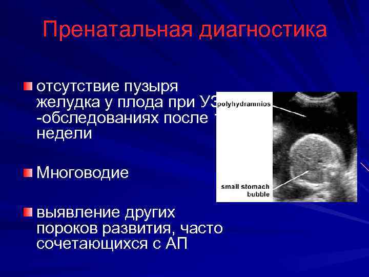 Пренатальная диагностика отсутствие пузыря желудка у плода при УЗИ -обследованиях после 18 недели Многоводие