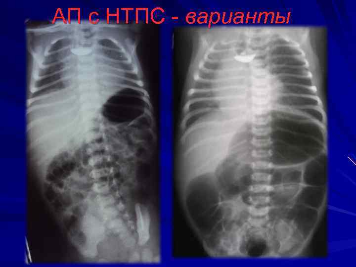 АП с НТПС - варианты 