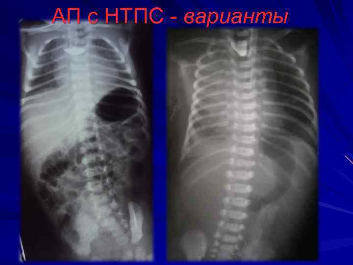 АП с НТПС - варианты 