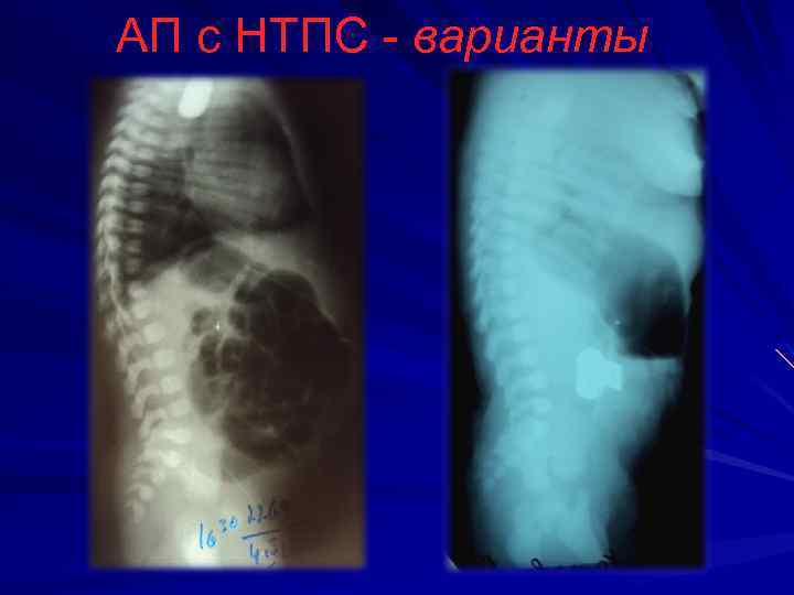 АП с НТПС - варианты 