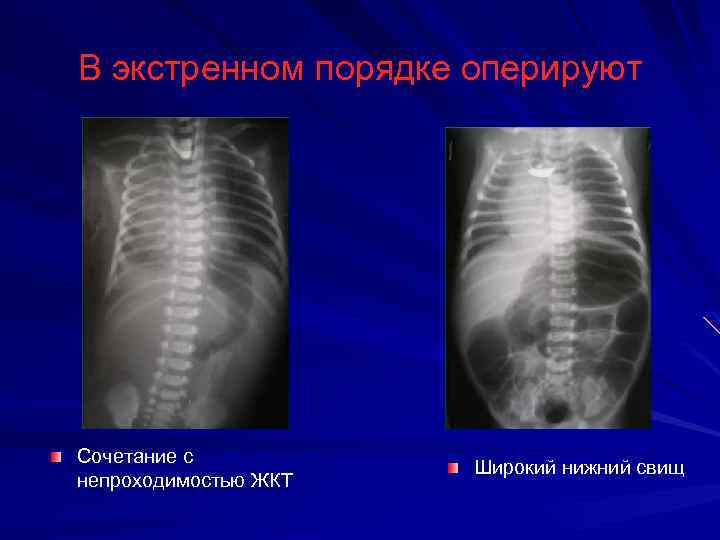 В экстренном порядке оперируют Сочетание с непроходимостью ЖКТ Широкий нижний свищ 