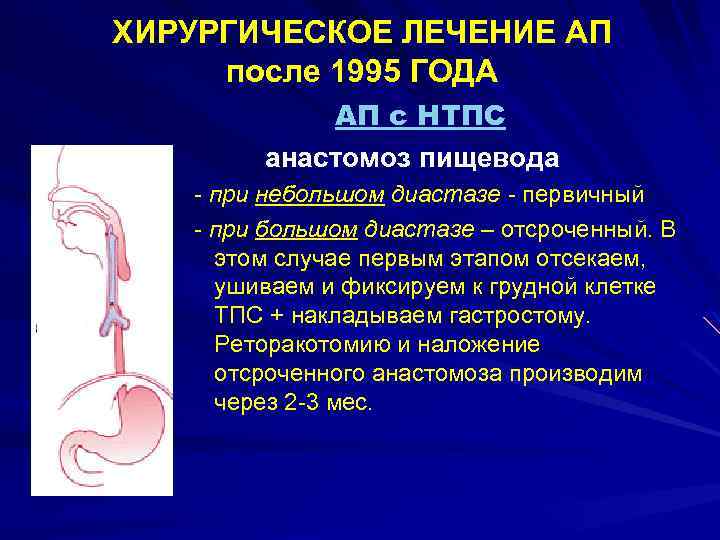 ХИРУРГИЧЕСКОЕ ЛЕЧЕНИЕ АП после 1995 ГОДА АП с НТПС анастомоз пищевода л рр л