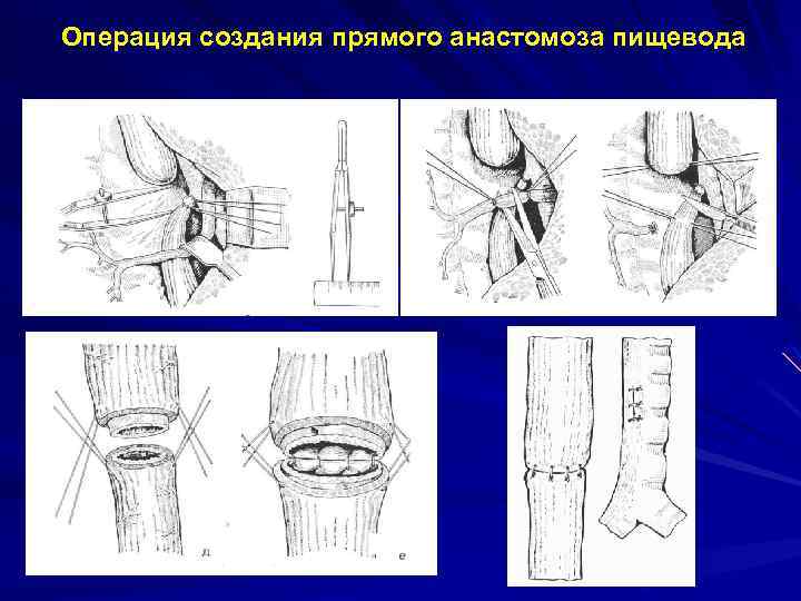 Операция создания прямого анастомоза пищевода рр рр рр 