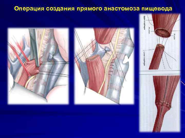 Впр пищевода