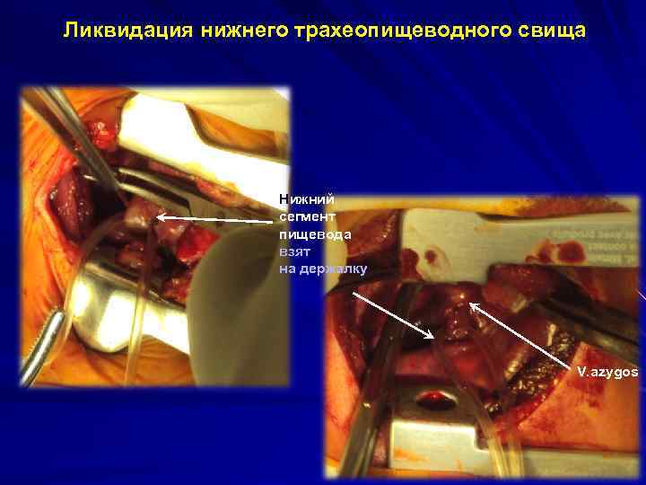 Ликвидация нижнего трахеопищеводного свища Нижний сегмент пищевода взят на держалку V. azygos 