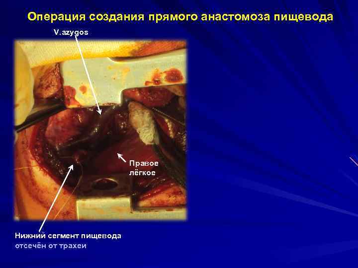 Операция создания прямого анастомоза пищевода V. azygos Правое лёгкое Нижний сегмент пищевода отсечён от