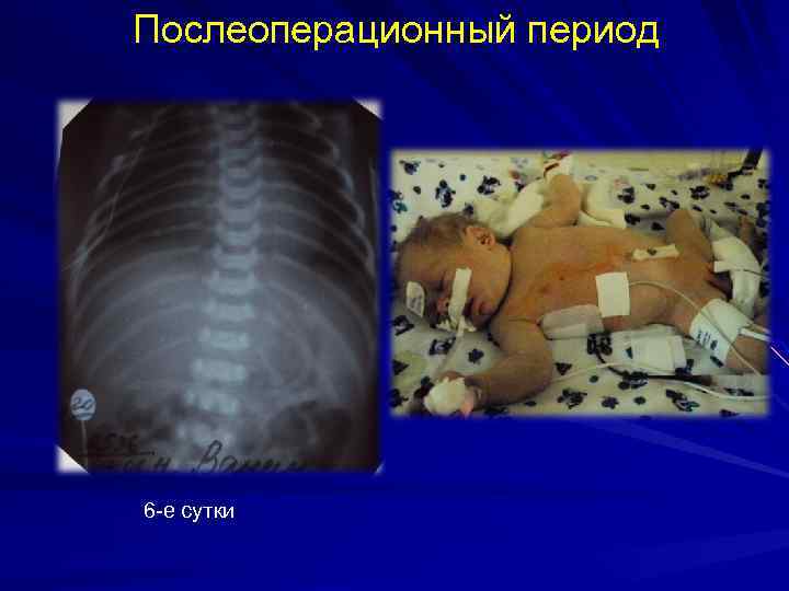 Послеоперационный период 6 -е сутки 