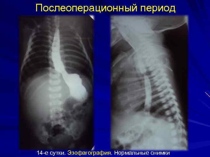 Послеоперационный период 14 -е сутки. Эзофагография. Нормальные снимки 
