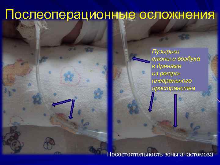 Послеоперационные осложнения Пузырьки слюны и воздуха в дренаже из ретроплеврального пространства Несостоятельность зоны анастомоза