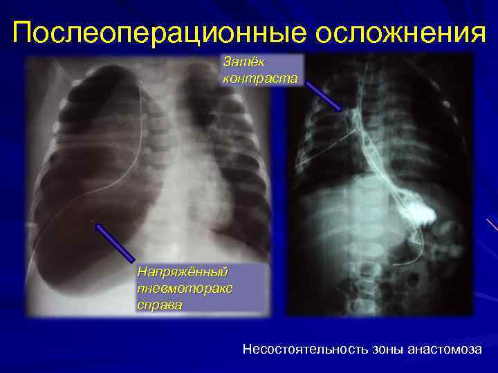 Послеоперационные осложнения Затёк контраста Напряжённый пневмоторакс справа Несостоятельность зоны анастомоза 