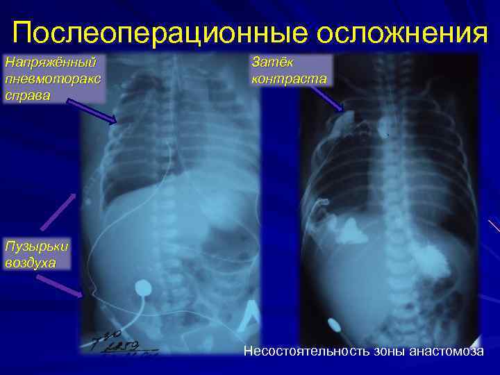 Послеоперационные осложнения Напряжённый пневмоторакс справа Затёк контраста Пузырьки воздуха Несостоятельность зоны анастомоза 
