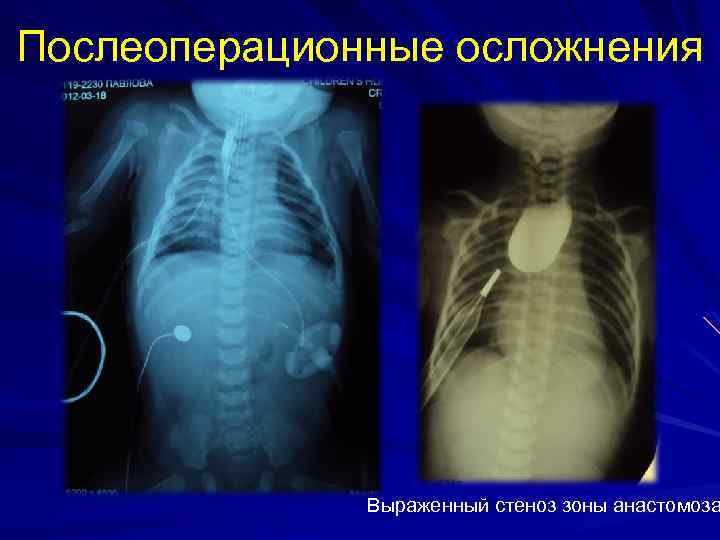 Послеоперационные осложнения Выраженный стеноз зоны анастомоза 