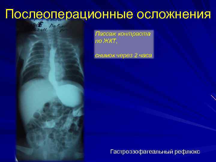 Послеоперационные осложнения Пассаж контраста по ЖКТ, снимок через 2 часа Гастроэзофагеальный рефлюкс 