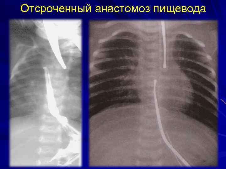 Отсроченный анастомоз пищевода 