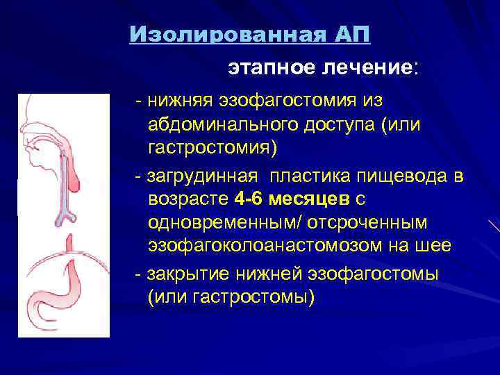 Изолированная АП этапное лечение: л рр - нижняя эзофагостомия из абдоминального доступа (или гастростомия)
